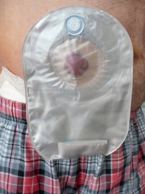 Ileostomy attached to the stomach of the patient close-up clipart
