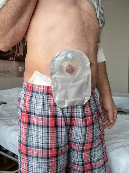 Paciente Demuestra Ileostomía Estómago Mientras Está Pie Una Sala Hospital — Foto de Stock