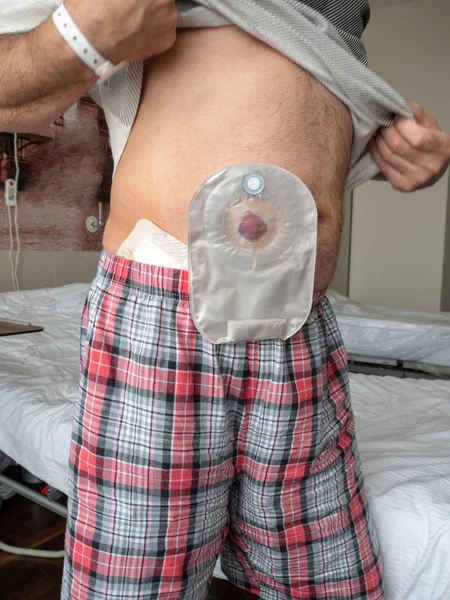 Patient Demonstrates Ileostomy His Stomach While Standing Hospital Ward — Stock Photo, Image
