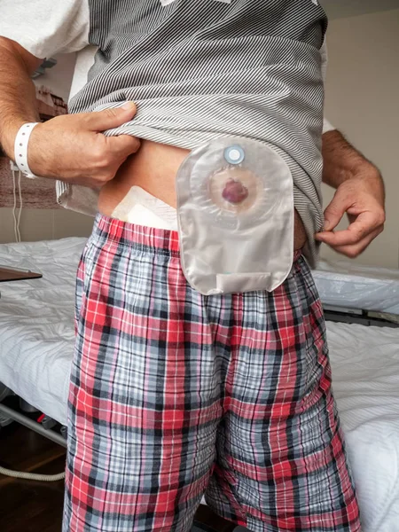 Pacjenta Pokazuje Ileostomię Brzuchu Stojąc Oddziale Szpitala — Zdjęcie stockowe