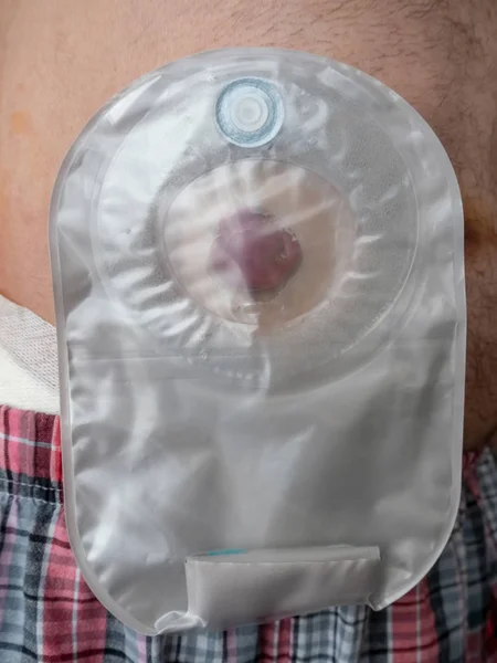 Ileostomía Adherida Estómago Del Paciente Cerca — Foto de Stock