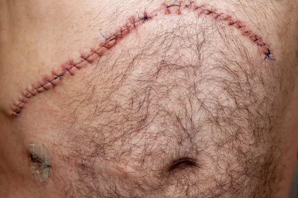肝臓上の腫瘍外科手術後の術後の縫合 腹部手術 排水のための穴の左下と病因から古い傷 — ストック写真
