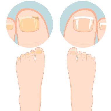Close up of two feet one with nail fungal infection and other healthy clipart