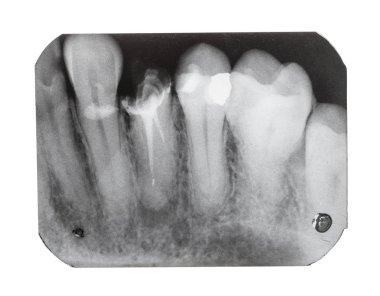 diş iğnesi ile dişlerin X-Ray görüntü ile film