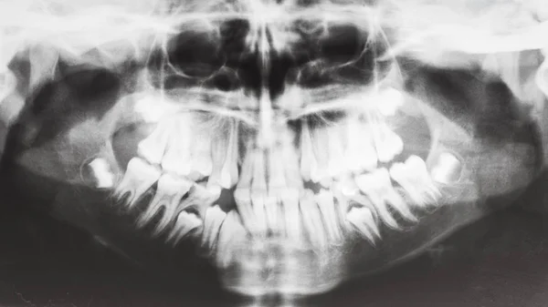 Menschliche Kiefer auf dem Röntgenbild — Stockfoto