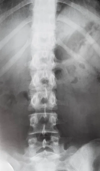 View of human spine in torso on X-ray image — Stock Photo, Image