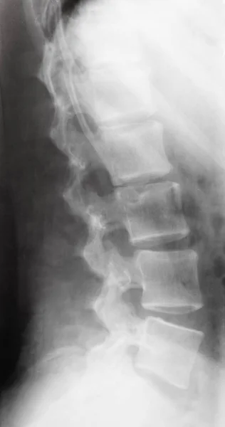 View of human spine on X-ray image — Stock Photo, Image