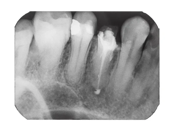 Imagem de raio-X de dentes humanos com pino dental — Fotografia de Stock