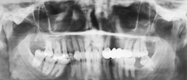 Dişler üzerinde diş taç ile insan çeneleri — Stok fotoğraf