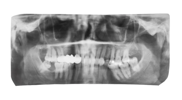 Film mit Röntgenbild von Kiefern mit Zahnkrone — Stockfoto