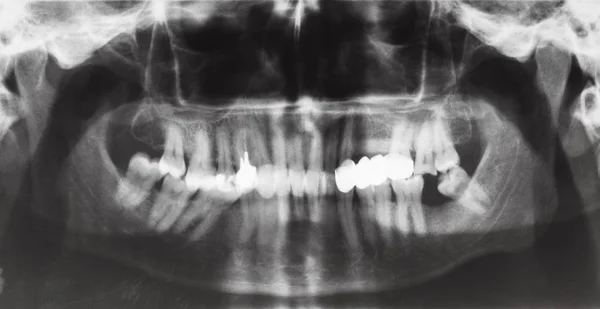 Челюсти человека с зубной короной и булавки в зубах — стоковое фото