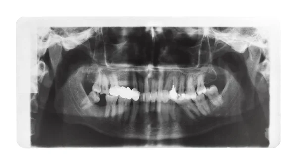 Película con imagen de rayos X de mandíbulas con alfileres dentales —  Fotos de Stock