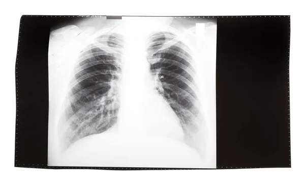 Film with X-ray image of human thorax — Stock Photo, Image