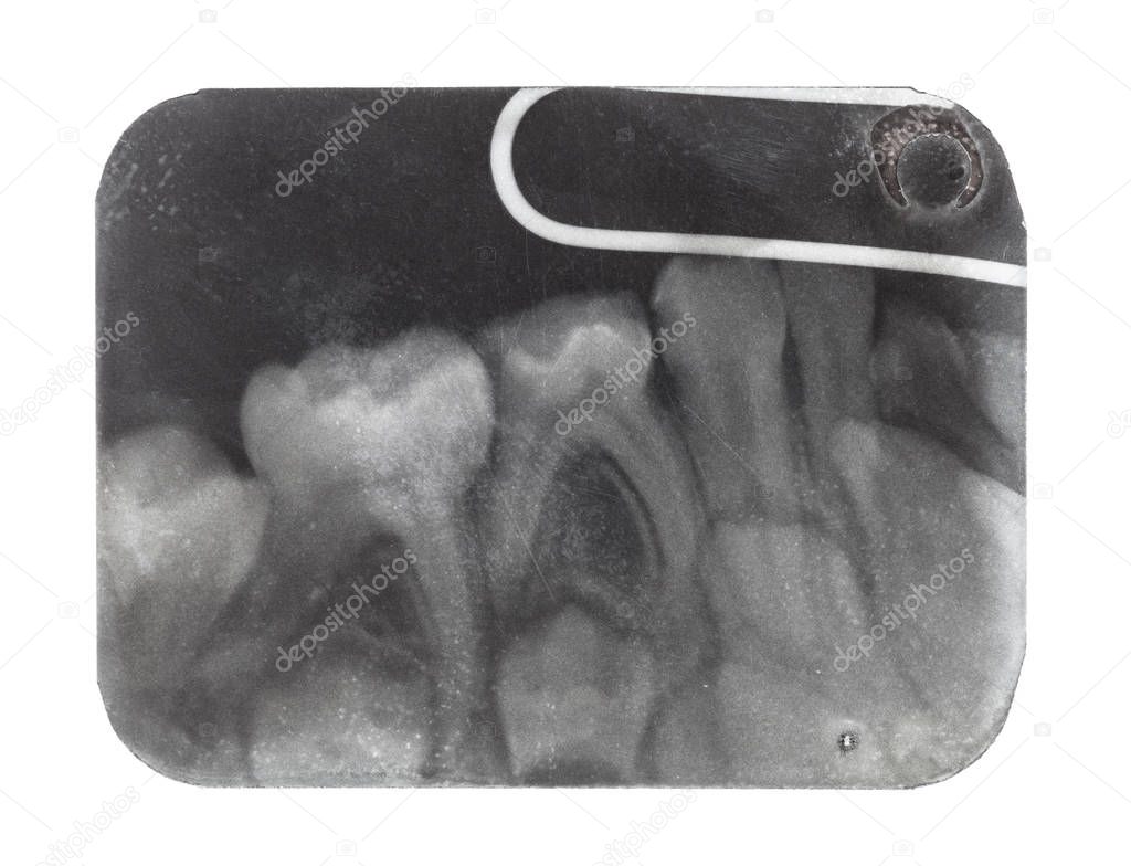 film with X-ray image of teeth close up isolated