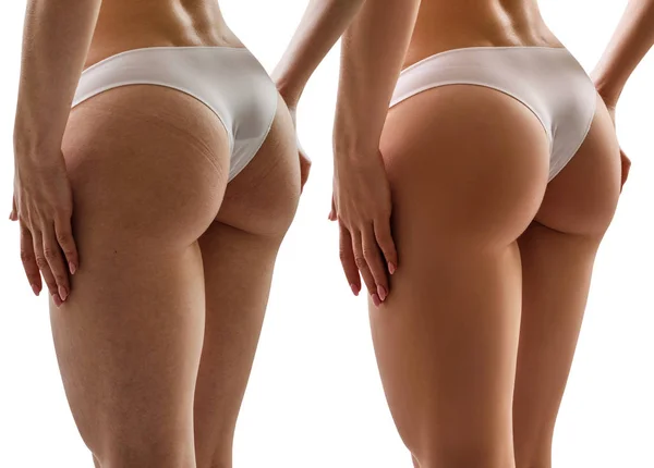 Fesses féminines avant et après traitement anti-cellulite . — Photo