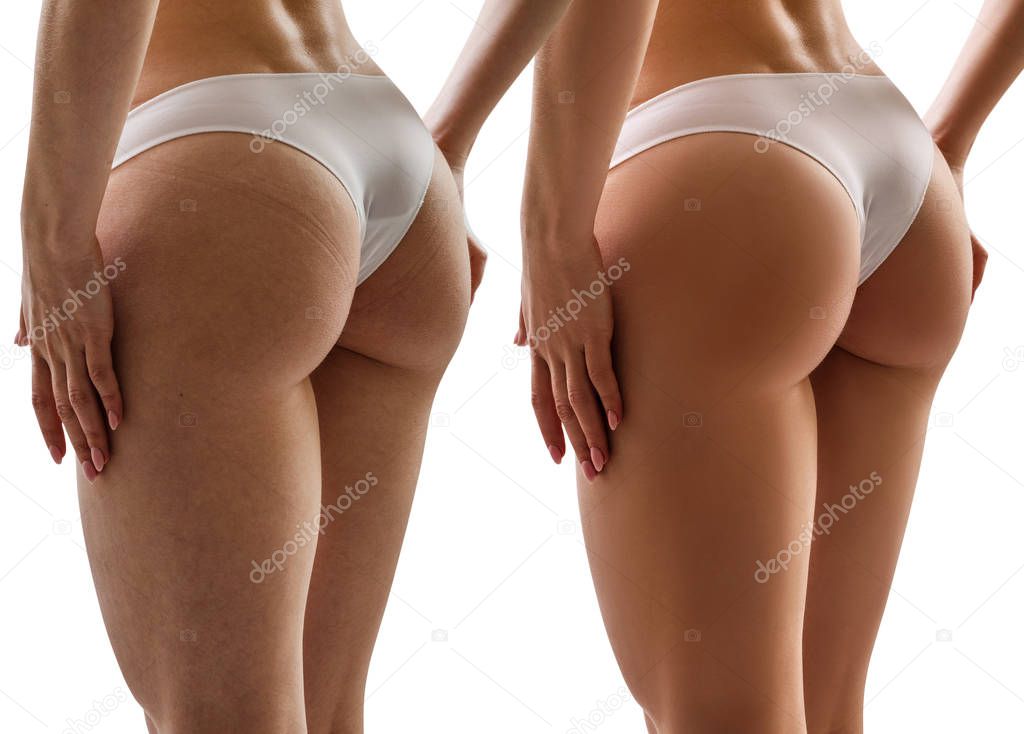 Female buttocks before and after anti-cellulite treatment.