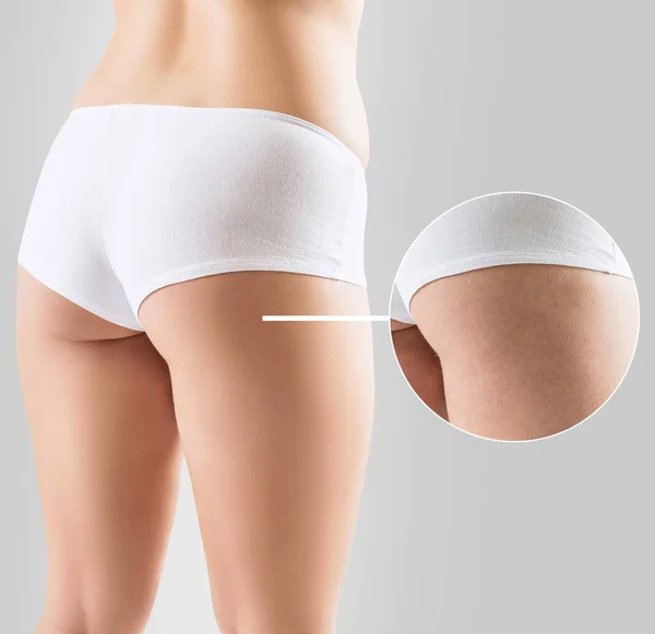 여성 엉덩이 셀룰라이트 치료 전후. — 스톡 사진