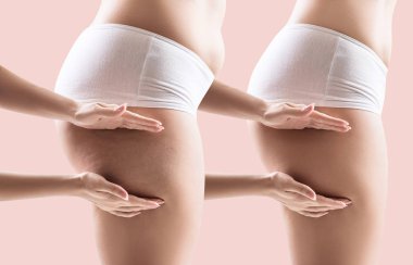 Kadın kalça öncesi ve sonrası zayıflama. Fitness kavramı.
