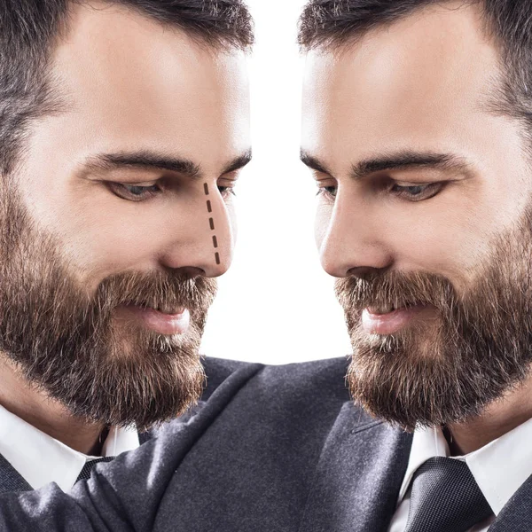 Cara masculina antes y después de la cirugía estética de la nariz . — Foto de Stock