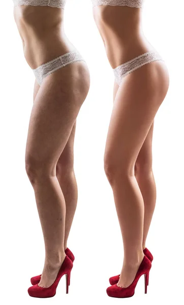 Voorwaarde van de huid van de benen van de vrouw voor en na behandeling. — Stockfoto
