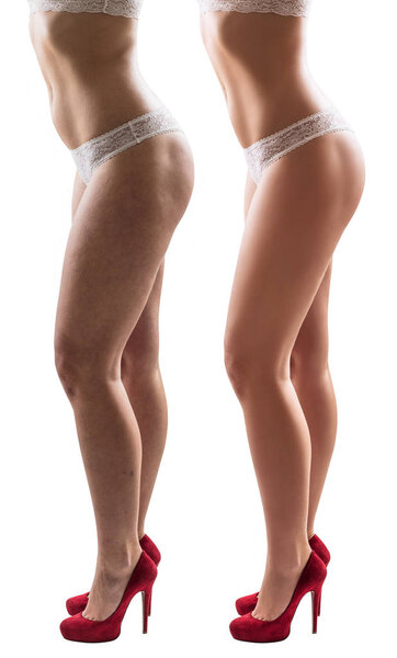 Woman legs before and after treatment skin condition.