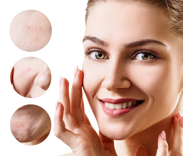 Zoom circles shows problem skin of young woman. — Stock Photo, Image