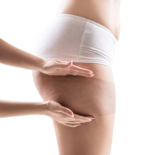 Female buttocks shows skin beforeand after treatment. — Stock Photo, Image