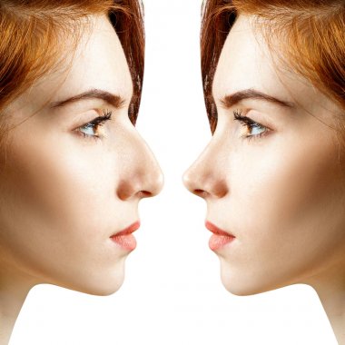 Female nose before and after cosmetic surgery. clipart