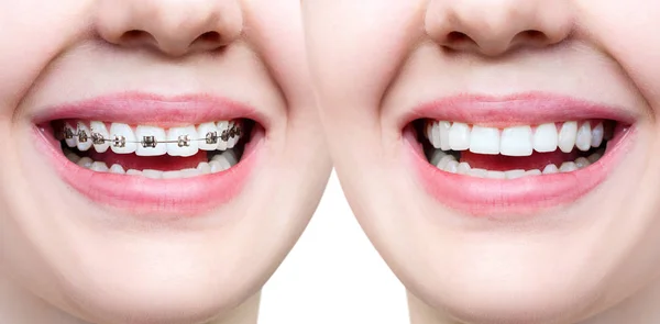 Piękny uśmiech z doskonałych zębów przed i po szelki. — Zdjęcie stockowe