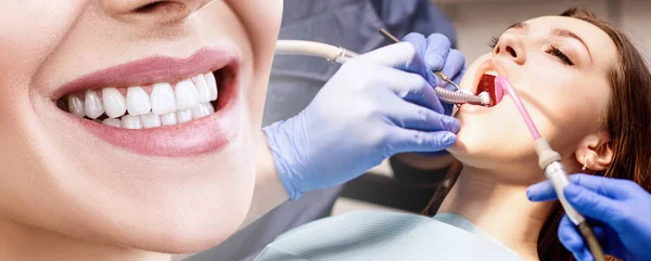 Collage de sourire parfait après une visite chez le dentiste . — Photo