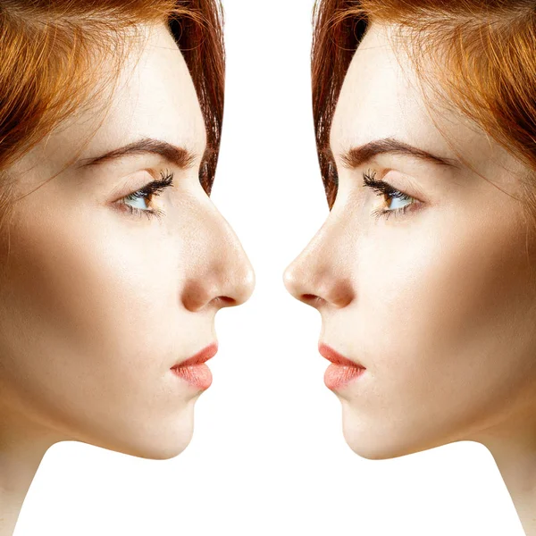 Vrouwelijke neus voor en na cosmetische chirurgie. — Stockfoto