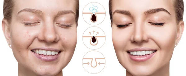 Graphically shows how to pollute and clean the pores on face. — Stock Photo, Image