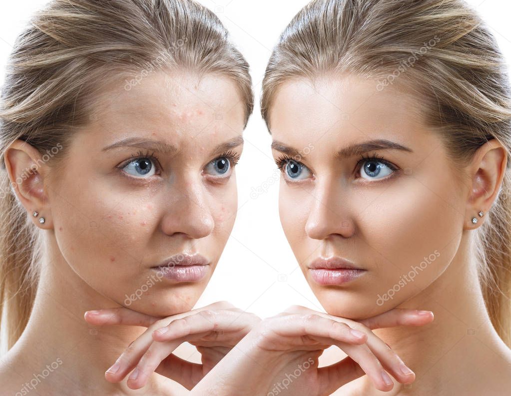 Young woman before and after skin treatment and makeup.