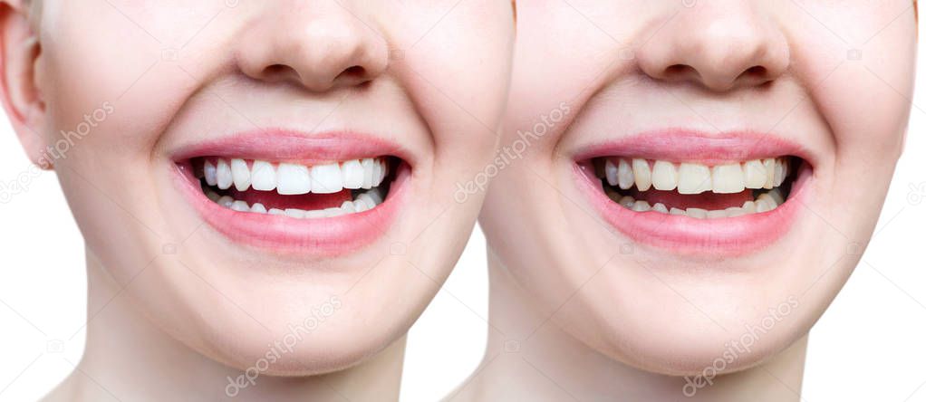 Teeth of young woman before and after whitening and buildup.