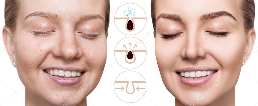 Graphically shows how to pollute and clean the pores on face.
