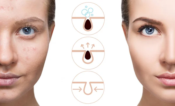 Graphically shows how to pollute and clean the pores on face. — Stock Photo, Image