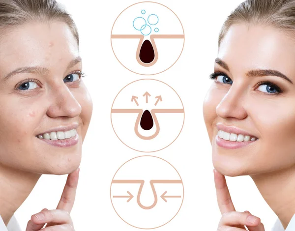 Grafiksel olarak yüz gözenekleri kirletmek ve temizlemek için nasıl gösterir.