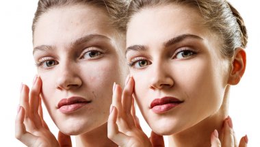 Genç şehvetli kadın önce ve sonra cilt tedavisi.