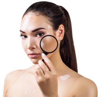 Vitiligo ile güzel kadın Büyüteç tutar.