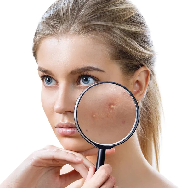 Ung kvinna med förstoringsglas visar hud med akne. — Stockfoto