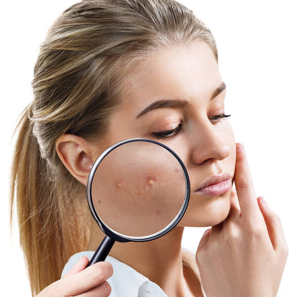 Young woman with magnifying glass shows skin with acne.