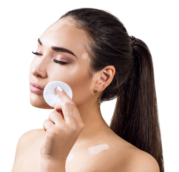 Hermosa joven con vitiligo limpiándose la cara con un disco de algodón . — Foto de Stock