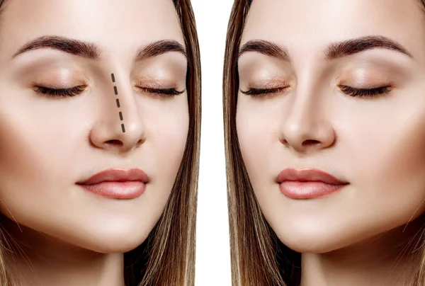 Female nose before and after cosmetic surgery. — Stock Photo, Image