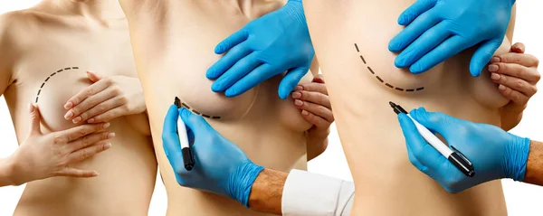 Collage. Cirugía plástica para corrección mamaria femenina . —  Fotos de Stock