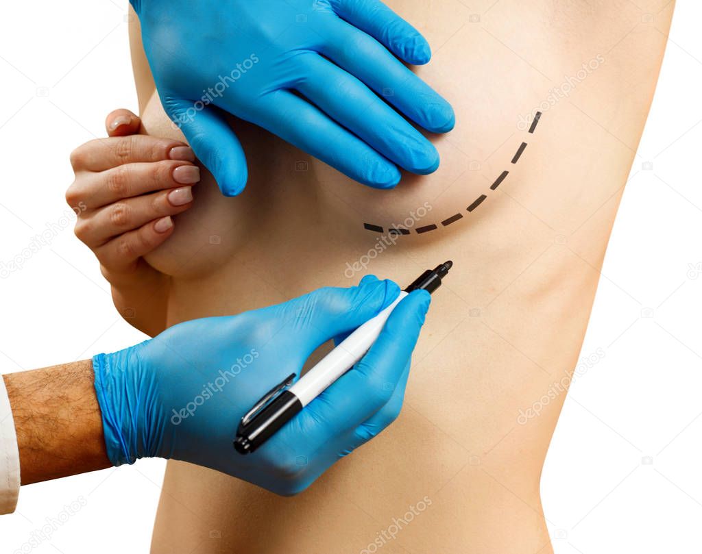 Plastic surgery before female breast correction.