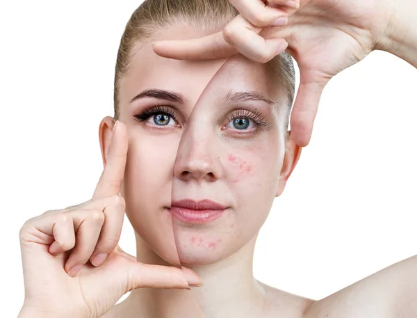 Jeune femme avant et après le traitement de la peau et le maquillage . — Photo