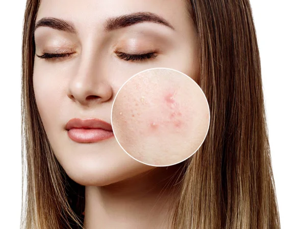 Jeune femme avec peau d'acné dans le cercle de zoom . — Photo