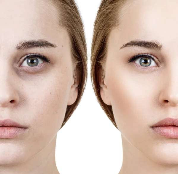 Mulher com hematomas sob os olhos antes e depois do tratamento cosmético . — Fotografia de Stock