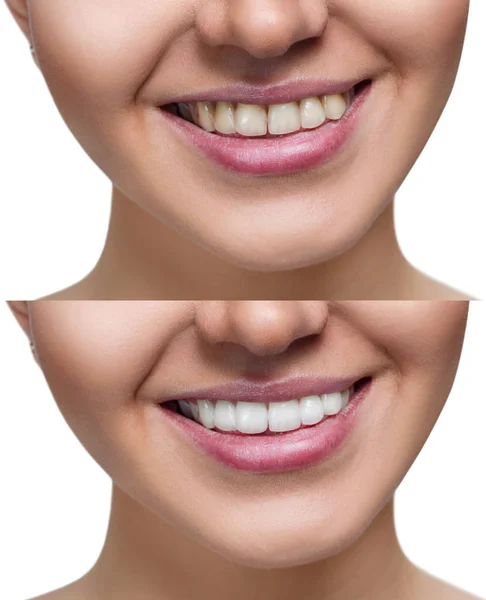 Tänder av ung kvinna före och efter Whitening. — Stockfoto