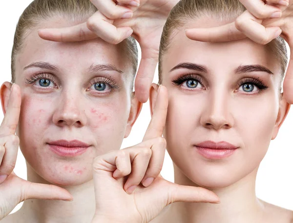 Młoda kobieta przed i po zabiegu i makijażu skóry. — Zdjęcie stockowe